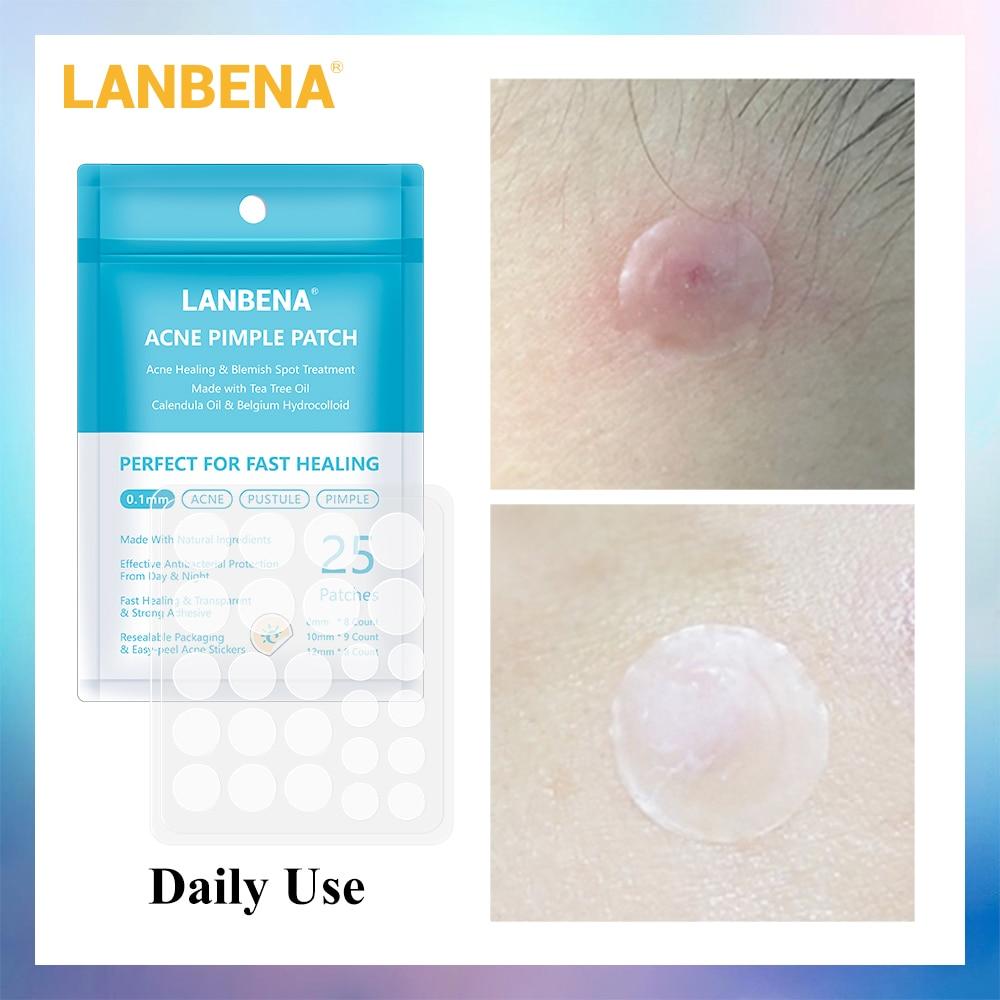 LANBENA Acne Pimple Patch 25pcs Daily Use Invisible Acne Stickers Blemish Treatment Acne Master Face Mask Beauty Tool Skin Care